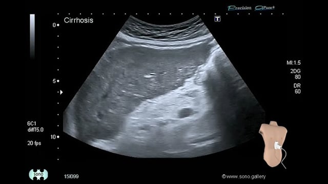 Cirrhosis