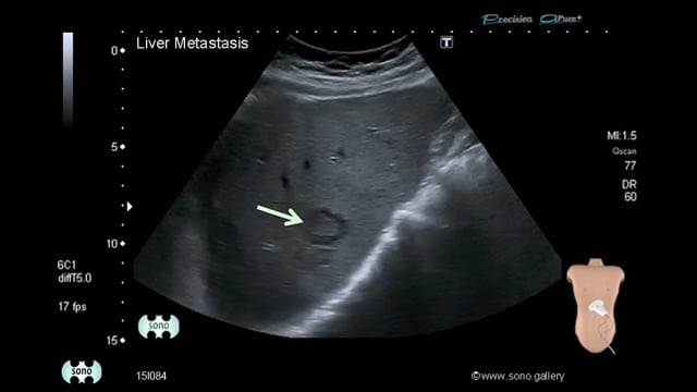 Liver Metastasis