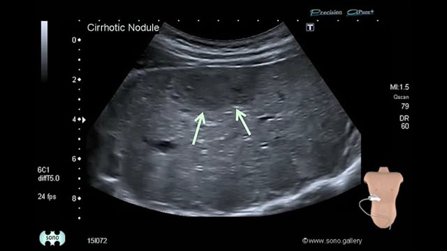 regenerative liver nodules