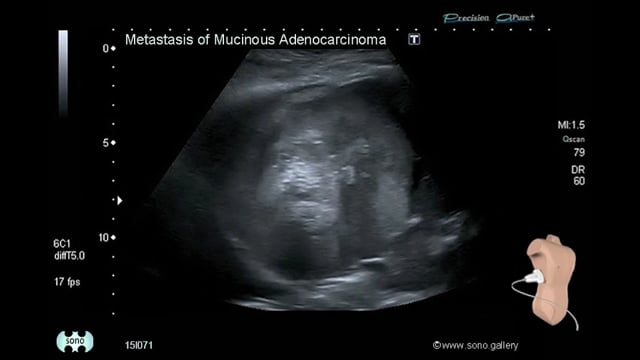 Metastasis of Mucinous Adenocarcinoma