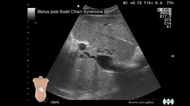 Status post Budd Chiari Syndrome