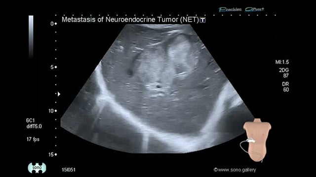Metastasis of Neuroendocrine Tumor (NET)