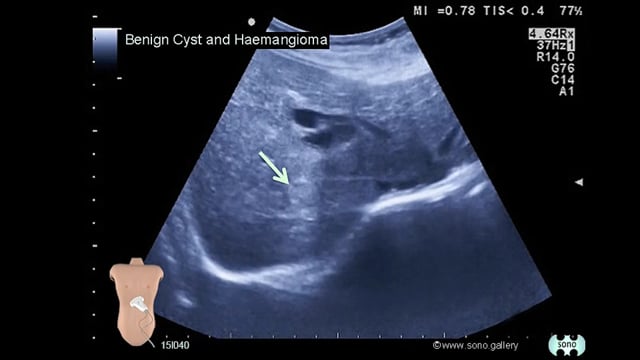 liver cyst and hepatic haemangioma