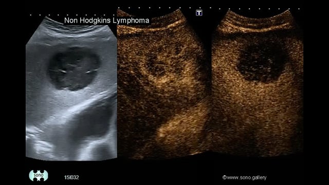 Non-Hodgkin lymphoma (NHL)