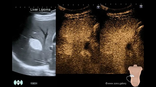 lipoma of the liver