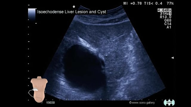 isoechoic liver lesion and cyst