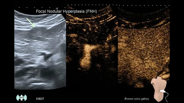 Focal Nodular Hyperplasia (FNH)