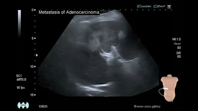 Metastasis of Adenocarcinoma