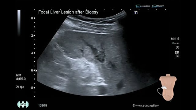 focal liver lesion after biopsy