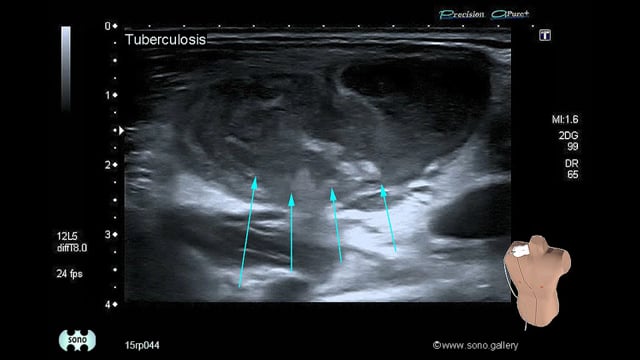 Tuberculosis