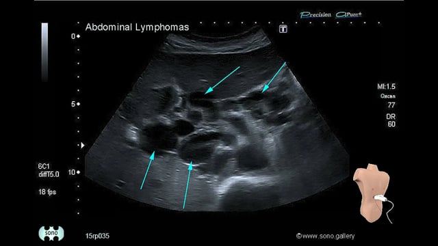 Abdominal Lymphomas