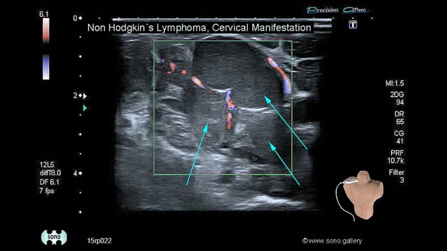 Non Hodgkin´s Lymphoma, Cervical Manifestation