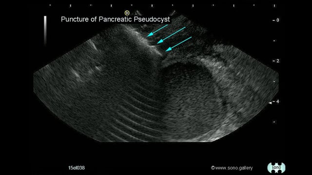 pancreatic pseudocyst, drainage