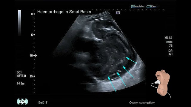 hemorrhage, pelvis