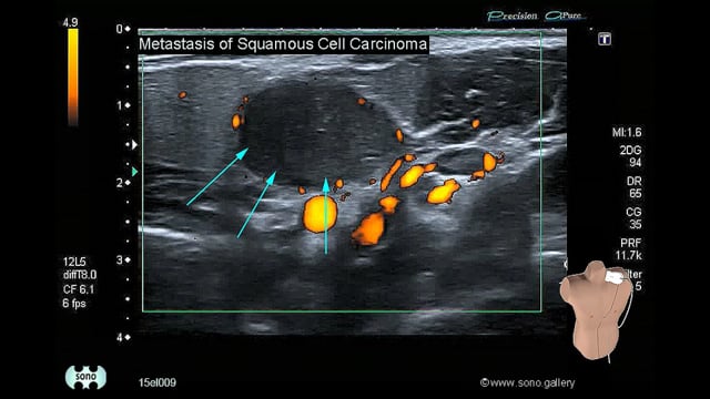 Metastasis of Squamous Cell Carcinoma