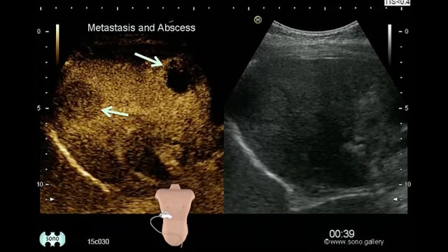 liver metastasis and abscess