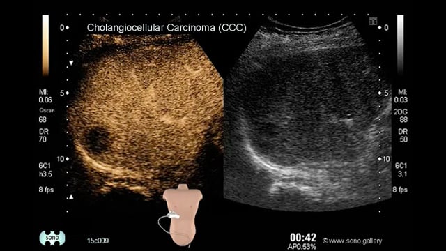 cholangiocarcinoma