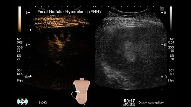 Focal Nodular Hyperplasia (FNH) - SONO.GALLERY