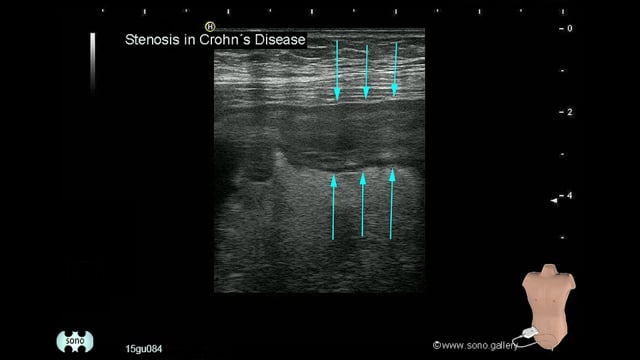 Crohn’s disease, intestinal stenosis