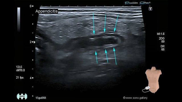 Appendicitis