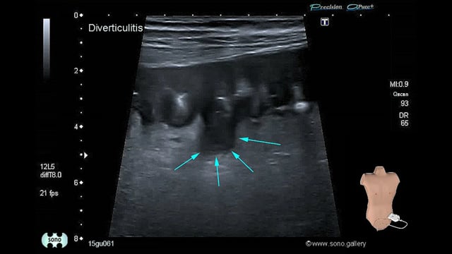 Diverticulitis