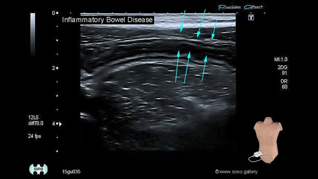 inflammatory bowel disease (IBD)