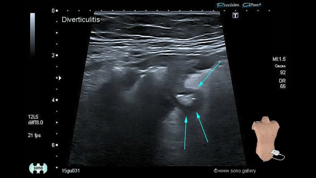 Diverticulitis