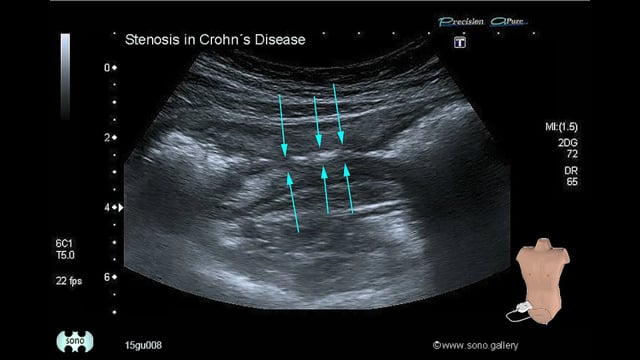 Crohn’s disease, intestinal stenosis