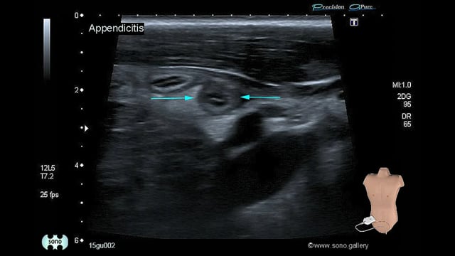 Appendicitis