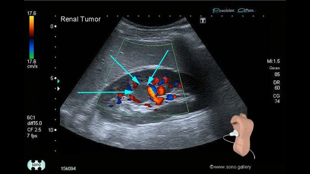 renal cell carcinoma