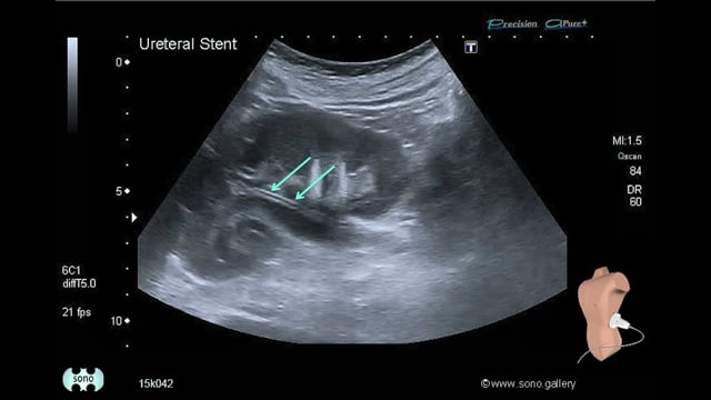Ureteral Stent