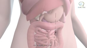 Open Removal of the Transverse Colon - English
