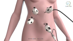 Laparoscopic Removal of the Gallbladder - English