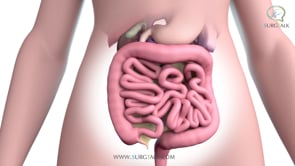 Laparoscopic Removal of the Sigmoid Colon - English