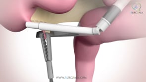 Laparoscopic Removal of the Appendix - English
