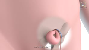 Laparoscopic Groin Hernia Repair - English