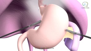 Laparoscopic Hiatal Hernia Repair with Nissen Fundoplication - English