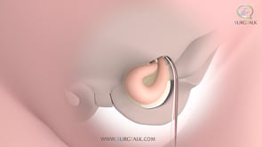 Open Groin (Inguinal) Hernia Repair - English
