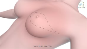 Modified Radial Mastectomy - English
