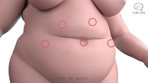 Laparoscopic Gastric Bypass - English