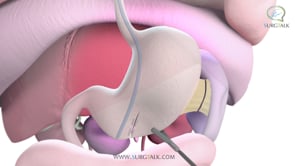 Laparoscopic Vertical Sleeve Gastrectomy - English
