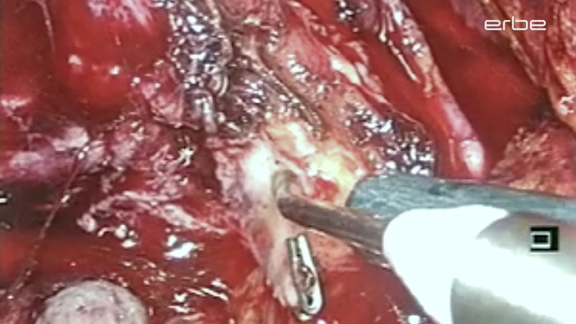 Prostatectomy, laparoscopic, with ERBEJET® 2