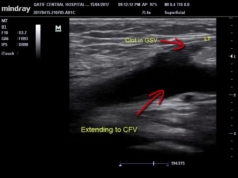 saphenofemoral junction thrombosis on Vimeo