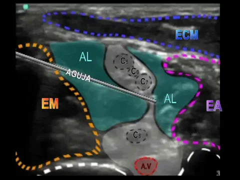 BLOQUEO INTERESCALÉNICO ECOGUIADO. on Vimeo