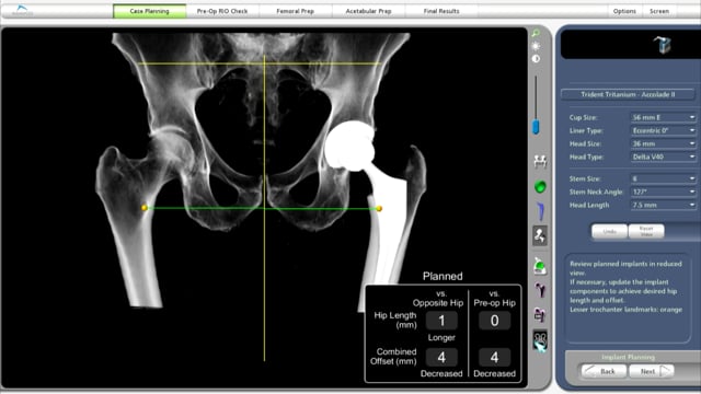 MAKO Robotic Assisted Total Hip Replacement (THR) For, 47% OFF
