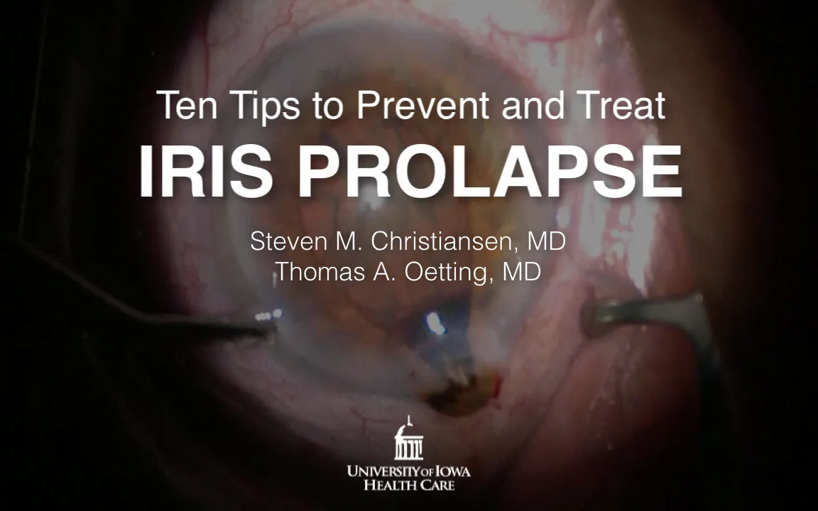 Ten Tips to Prevent and Treat Iris Prolapse
