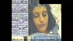 Epilepsia partialis continua in 16-year-old girl