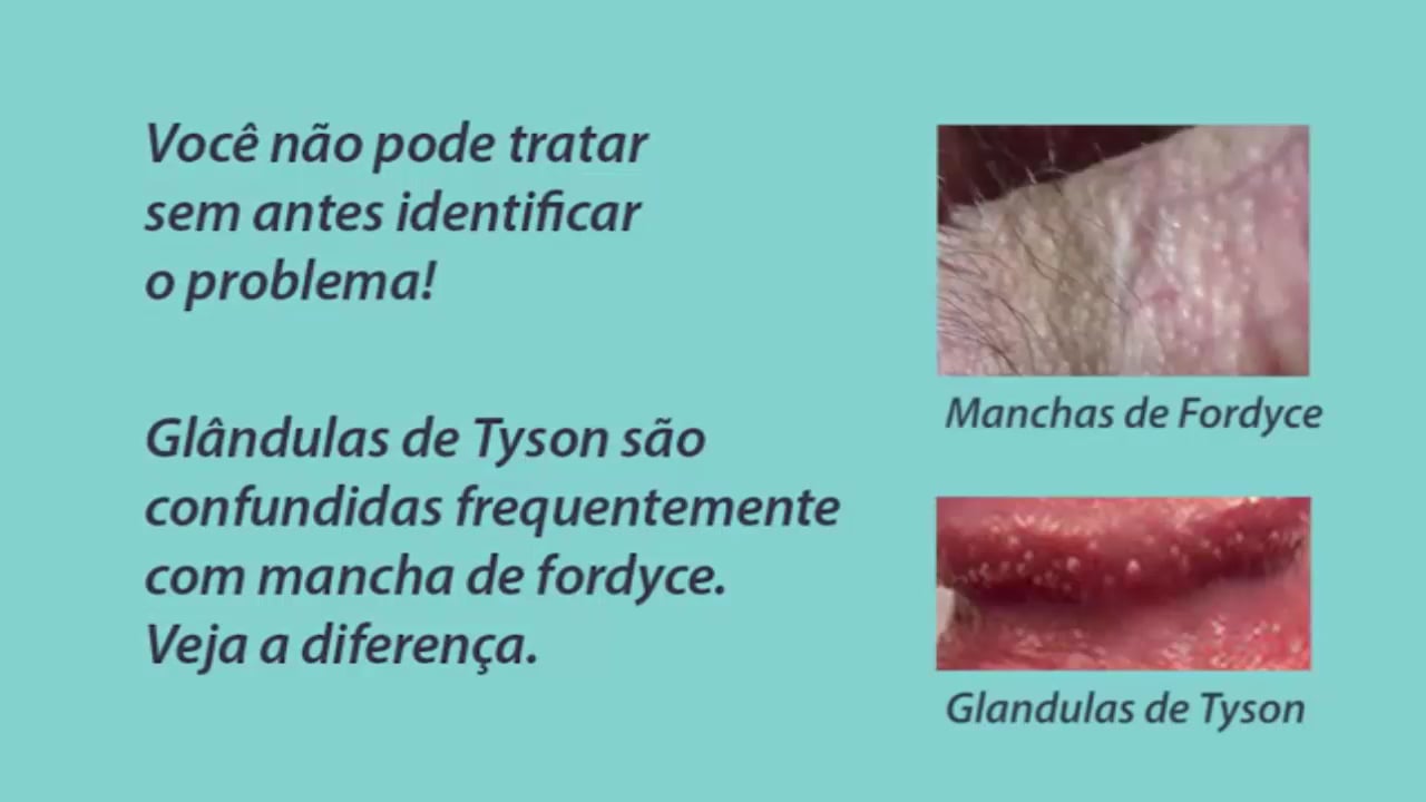 Glandulas de tyson como remover