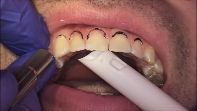 Esthetic Gingivectomy by Dr. Jeff Rohde (GNY)
