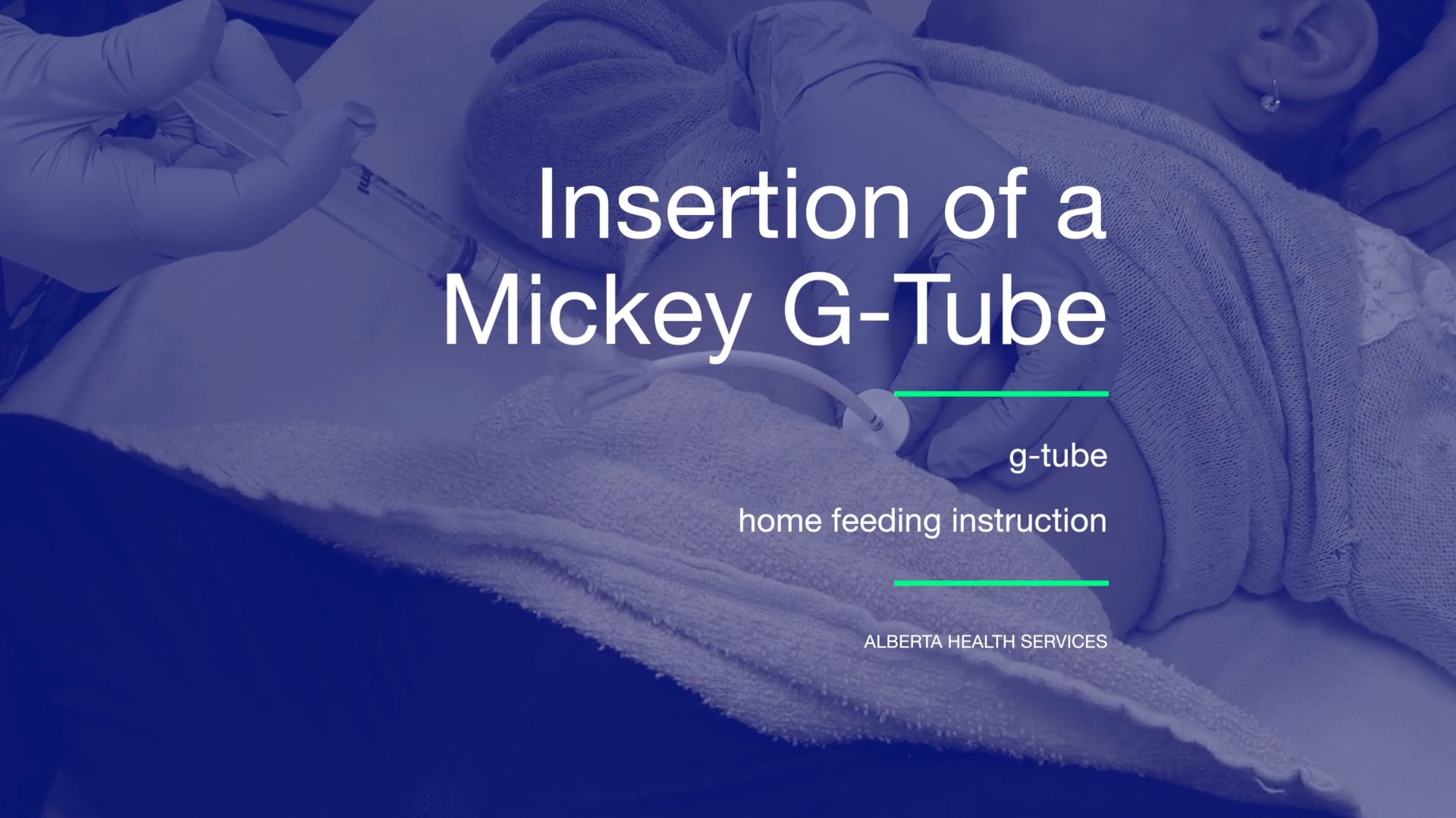 Insertion of a Mickey G-Tube